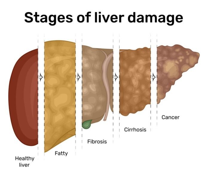 Fatty Liver